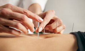 PreparingforPregancy_Accupuncture